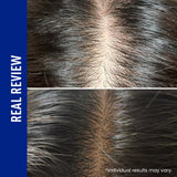 ViveLab Spioxyl™ スカルプセラム 400 ― 22万本マイクロスピキュールで、根元からふんわり濃密ヘアへ|韓国No.1売上・皮膚科医推奨のK-Beautyスカルプセラム(15ml)