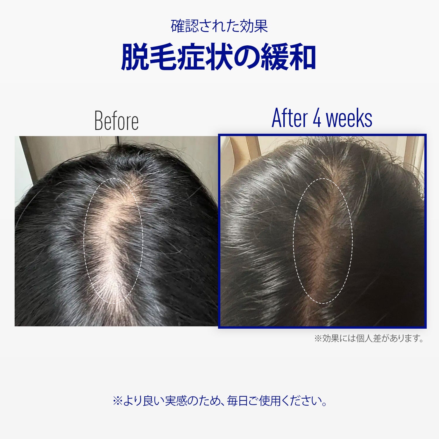 ViveLab Spioxyl™ スカルプセラム 400 ― 22万本マイクロスピキュールで、根元からふんわり濃密ヘアへ｜韓国No.1売上・皮膚科医推奨のK-Beautyスカルプセラム（15ml）