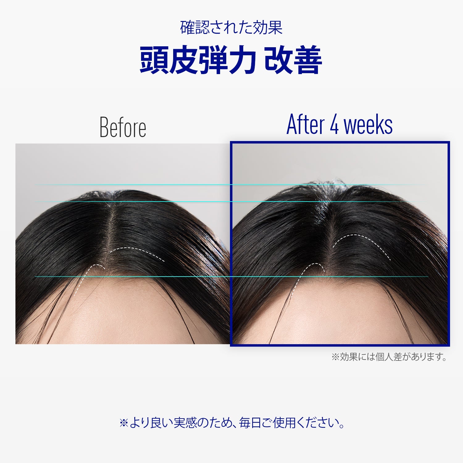 ViveLab Spioxyl™ スカルプセラム 400 ― 22万本マイクロスピキュールで、根元からふんわり濃密ヘアへ｜韓国No.1売上・皮膚科医推奨のK-Beautyスカルプセラム（15ml）